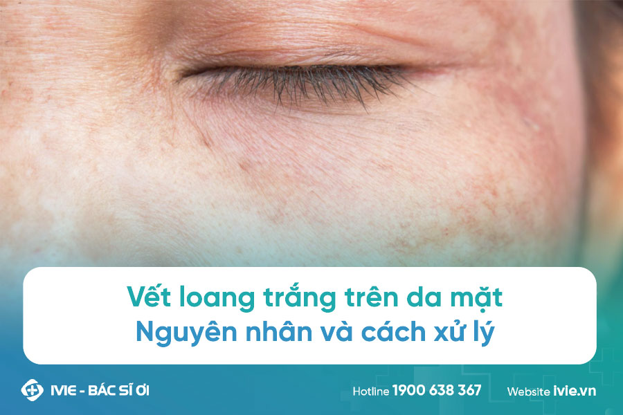 Cách Trị Da Mặt Bị Đốm Trắng Hiệu Quả Gallery 1