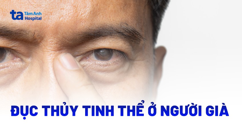 Đục thủy tinh thể người già là gì? Gallery 1