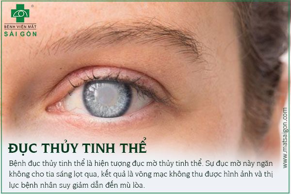 Đui Mù Là Gì? Nguyên Nhân, Triệu Chứng Và Cách Điều Trị Gallery 1