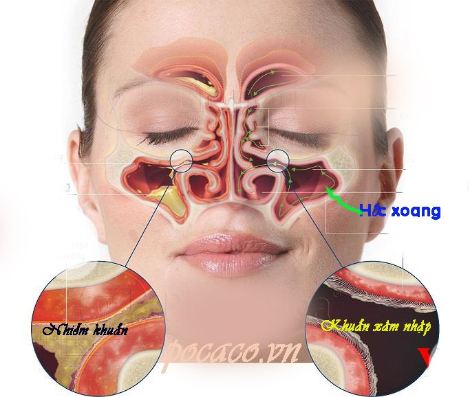 Bị Hắt Xì Liên Tục Và Chảy Nước Mũi: Nguyên Nhân Và Cách Khắc Phục Gallery 1