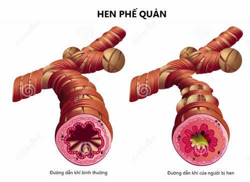 Hen phế quản bội nhiễm là gì? Gallery 1