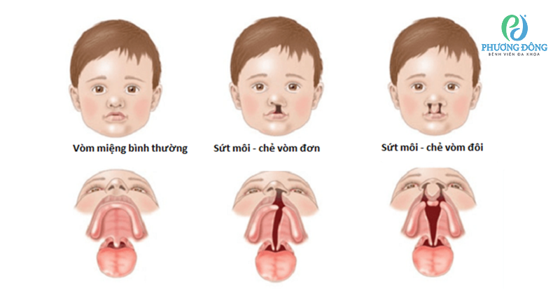 Nguyên nhân gây hở hàm ếch