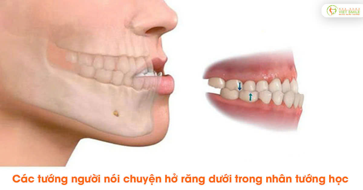 Nói chuyện hở răng dưới: Nguyên nhân và cách khắc phục Gallery 1