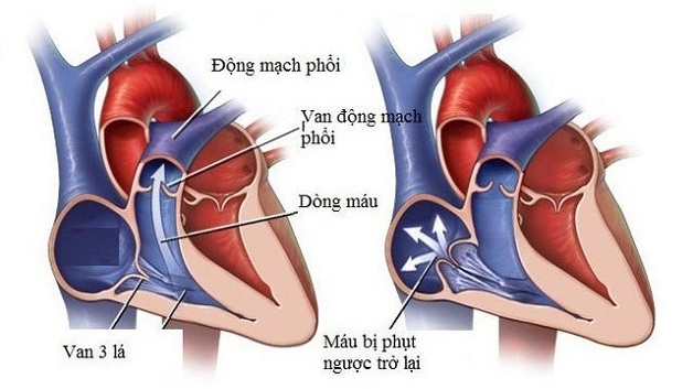 Hở Van Tim 3 Lá Gallery 2