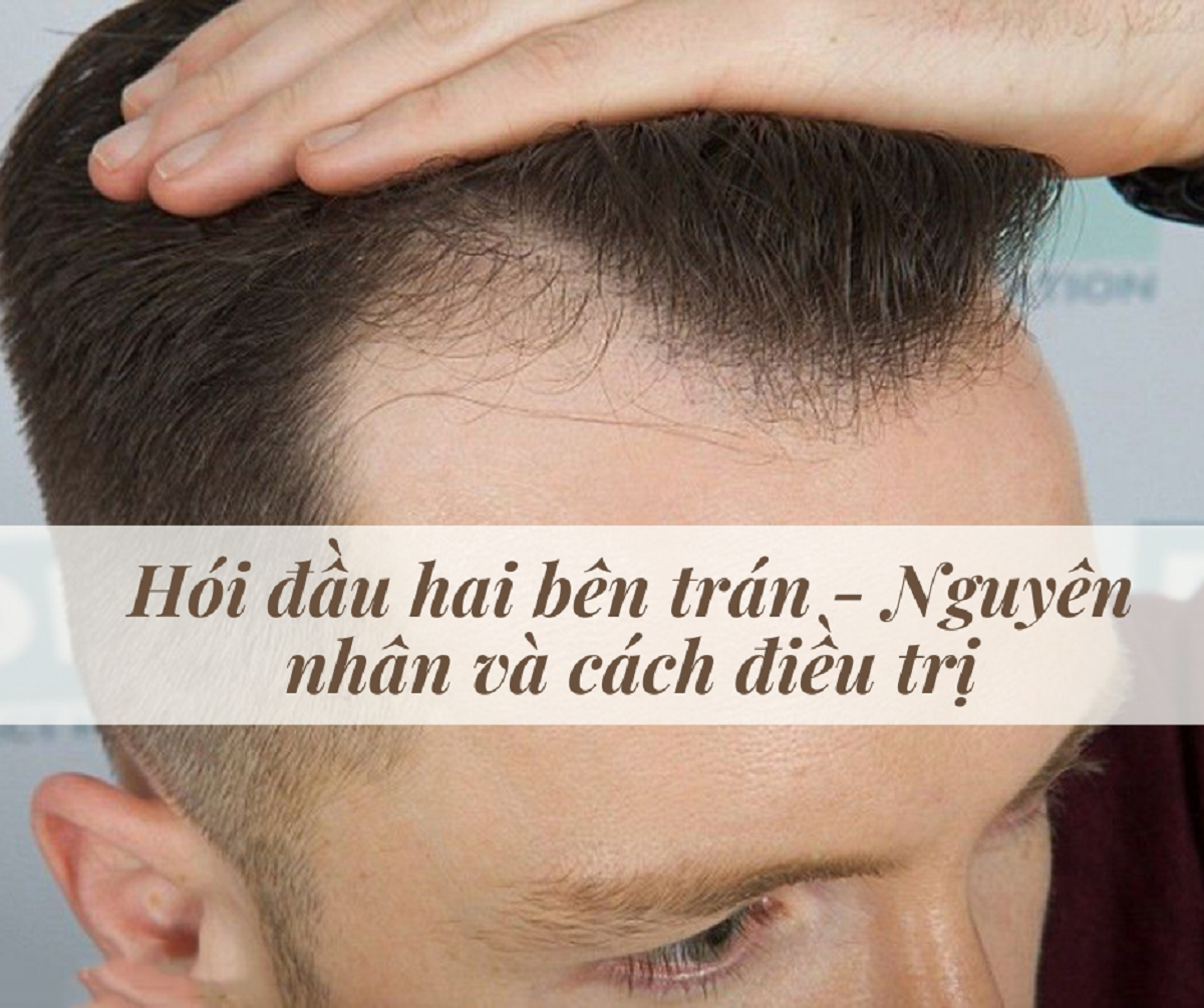 Trán cao có bị hói không? Gallery 2