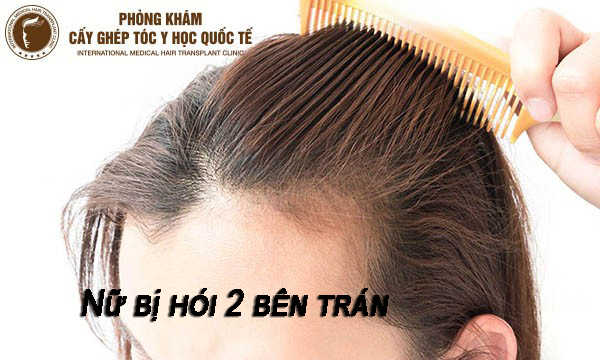 Cách Trị Hói Trán Ở Nữ Gallery 1