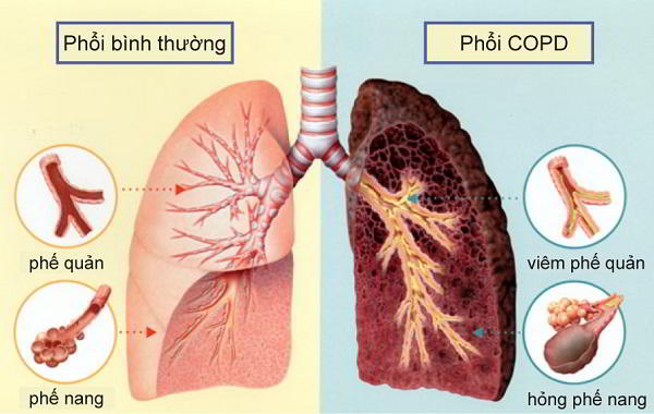 Khí Phế Thủng Là Gì? Gallery 1