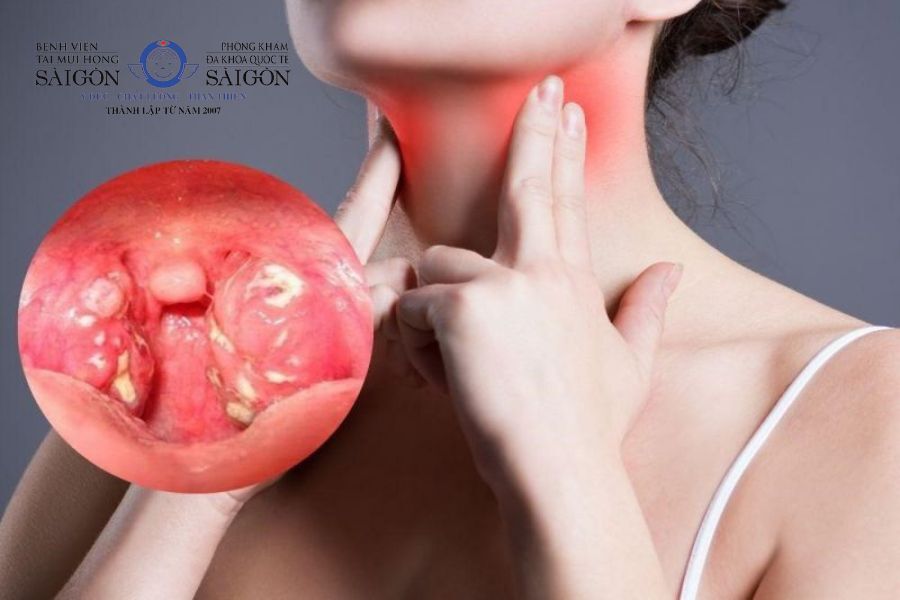 Khô Cổ Họng, Khát Nước: Nguyên Nhân và Cách Khắc Phục Gallery 1