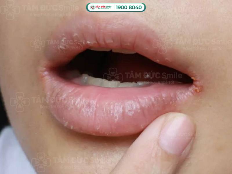Khô Hai Bên Mép Miệng: Nguyên Nhân Và Cách Khắc Phục Gallery 1
