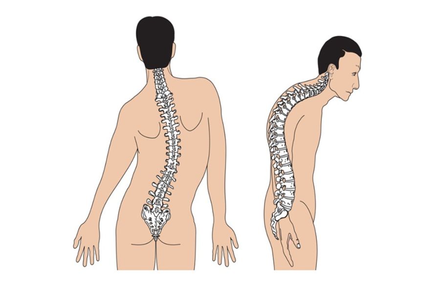 Lệch Đốt Sống Lưng: Nguyên Nhân, Triệu Chứng và Cách Điều Trị Gallery 1