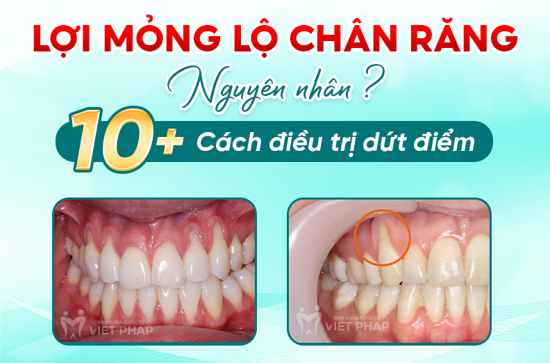 Lợi mỏng lộ chân răng Gallery 1