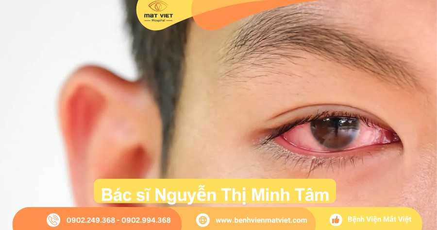 Lòng Trắng Mắt Bị Phồng Rộp: Nguyên Nhân, Triệu Chứng Và Cách Điều Trị Gallery 1