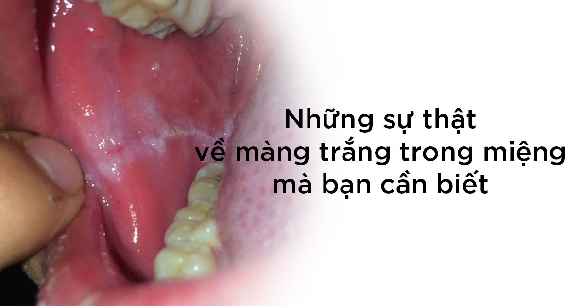 Mảng trắng trong miệng sau khi đánh răng: Nguyên nhân và cách khắc phục Gallery 1