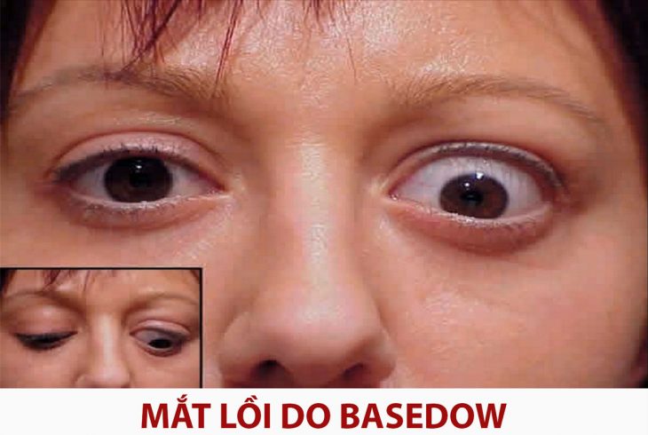 Mắt Bị Lồi 1 Bên: Nguyên Nhân, Triệu Chứng và Điều Trị Gallery 1