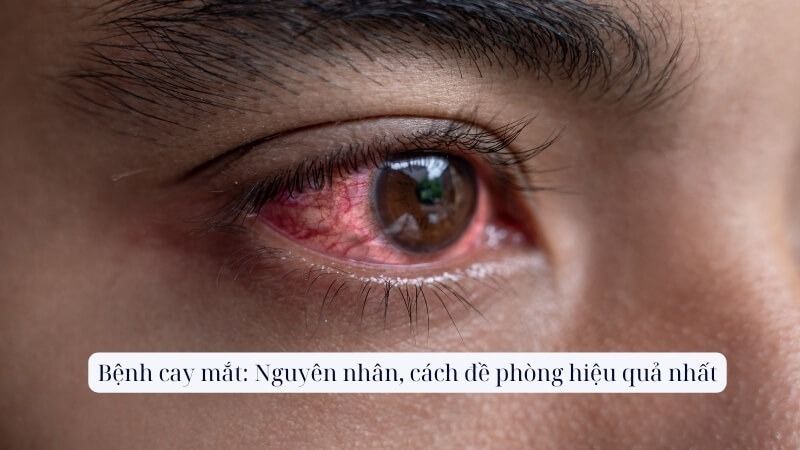 Mắt Cay Xè: Nguyên Nhân và Cách Khắc Phục Gallery 1