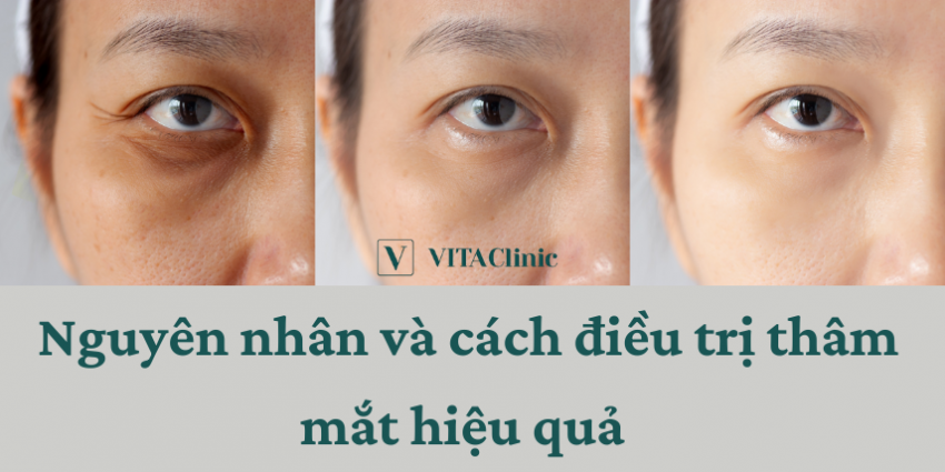 Mắt thâm quầng phải làm sao? Gallery 1