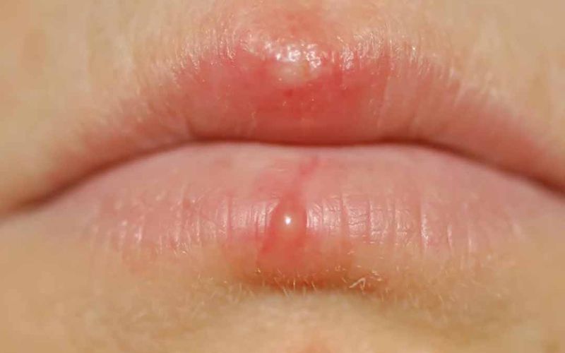 Môi Bị Rộp Nước: Nguyên Nhân, Cách Điều Trị Và Phòng Ngừa Gallery 1