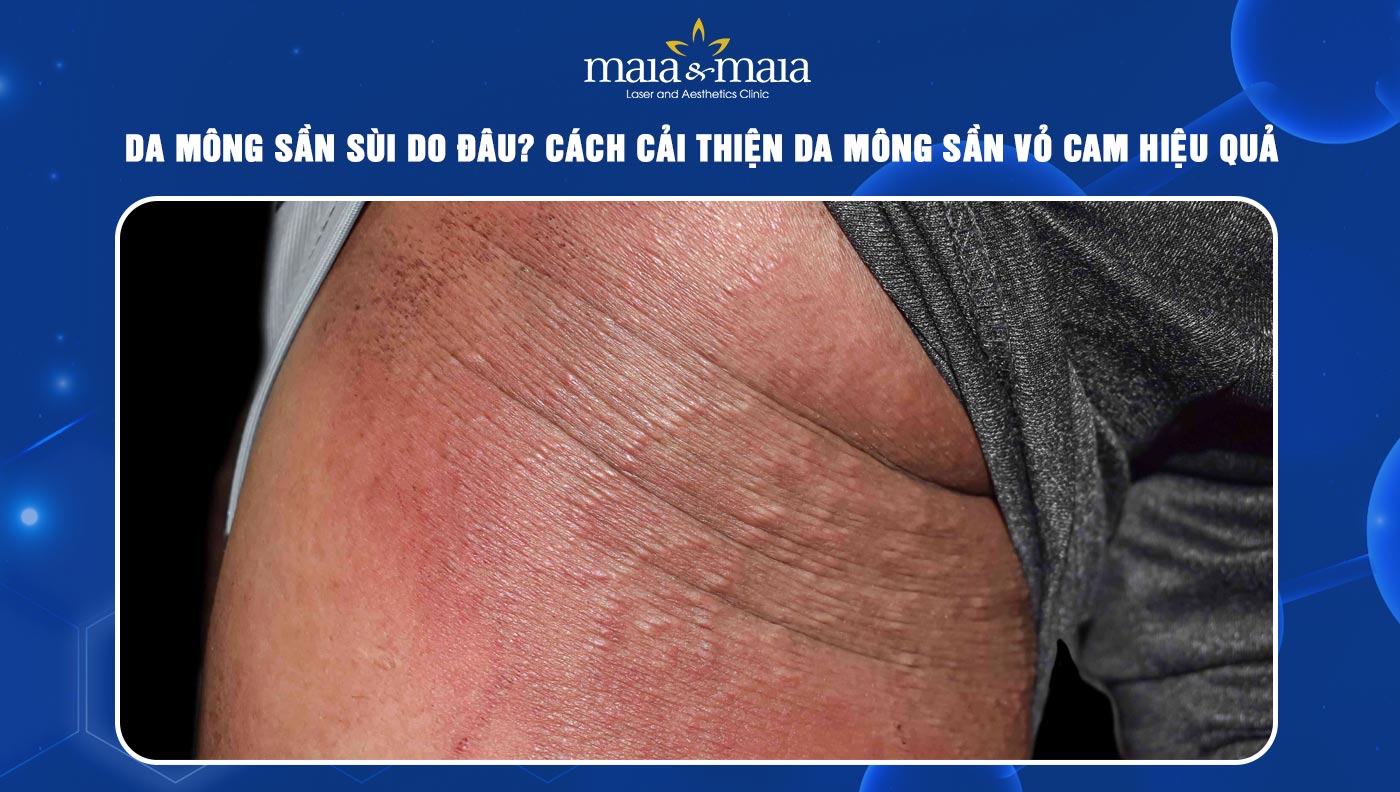 Trị Mông Sần Sùi Hiệu Quả Tại Nhà & Tại Spa Gallery 1