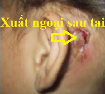 Sau vành tai có mùi hôi: Nguyên nhân và cách khắc phục Gallery 1