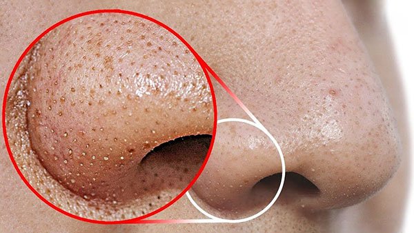 Mụn 2 Bên Cánh Mũi: Nguyên Nhân, Cách Điều Trị Và Phòng Ngừa Gallery 1
