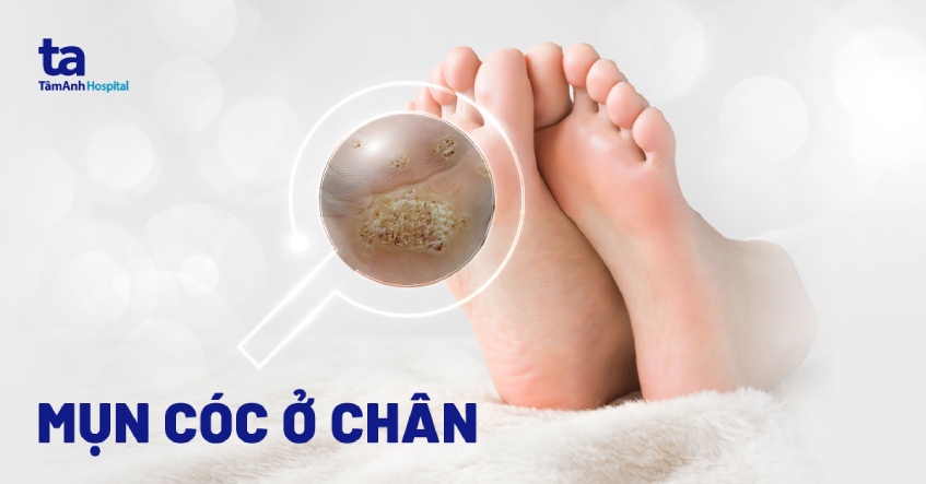 Mụn Bọc Ở Chân: Nguyên Nhân, Cách Điều Trị Và Phòng Ngừa Gallery 1