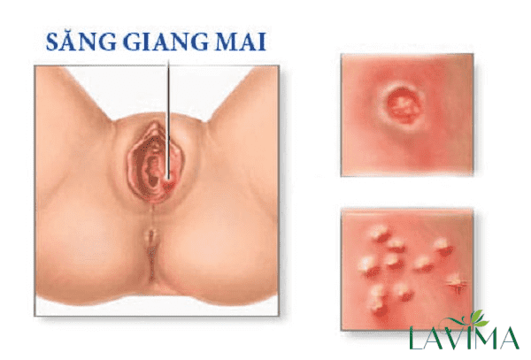 Mọc Mụn Ở Âm Đạo Gallery 1