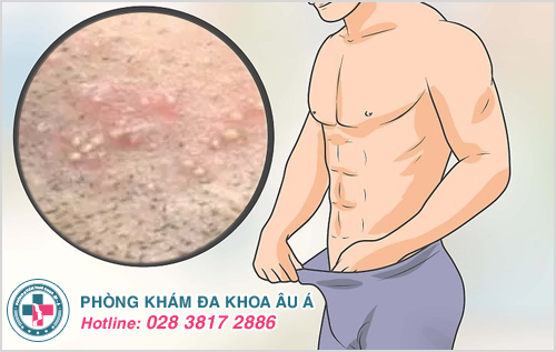 Mụn Trắng Ở Bộ Phận Sinh Dục Nam: Nguyên Nhân, Triệu Chứng Và Cách Điều Trị Gallery 1