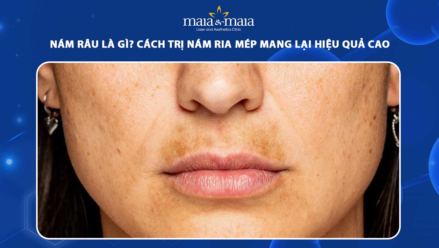 Cách Trị Nám Hàm Râu Hiệu Quả Gallery 1