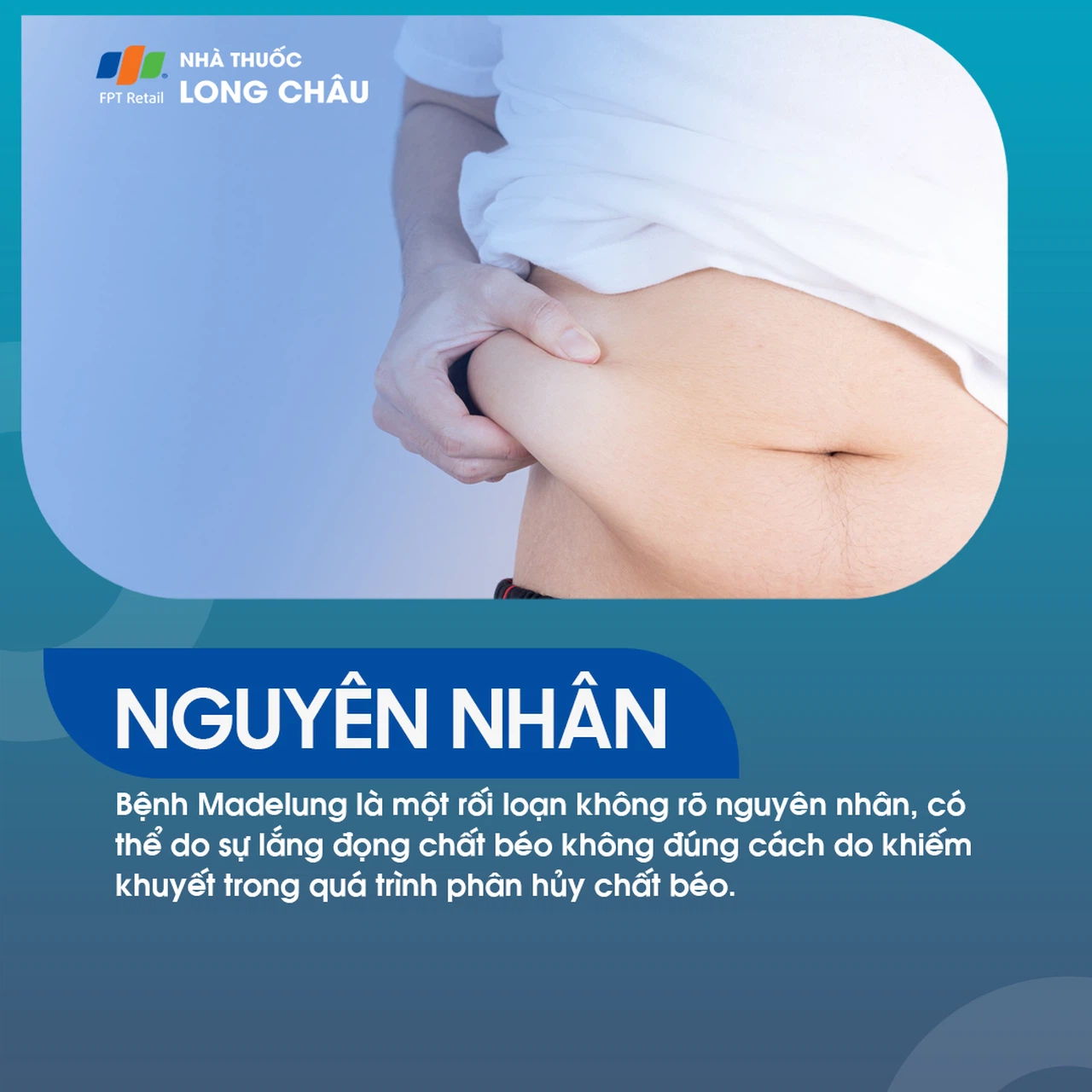 Hội chứng Adele là gì? Gallery 1