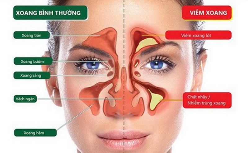 Nghẹt 2 Bên Mũi: Nguyên Nhân, Triệu Chứng Và Cách Khắc Phục Gallery 1