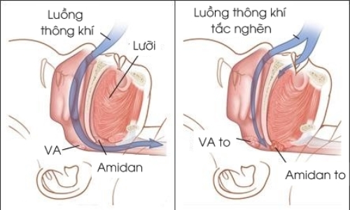 Ngủ Ngáy Và Cách Khắc Phục Gallery 1