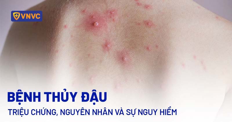 Thủy đậu có ngứa không? Gallery 2