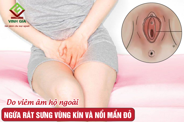 Vùng kín bị ngứa nổi mẩn đỏ: Nguyên nhân và cách điều trị Gallery 1