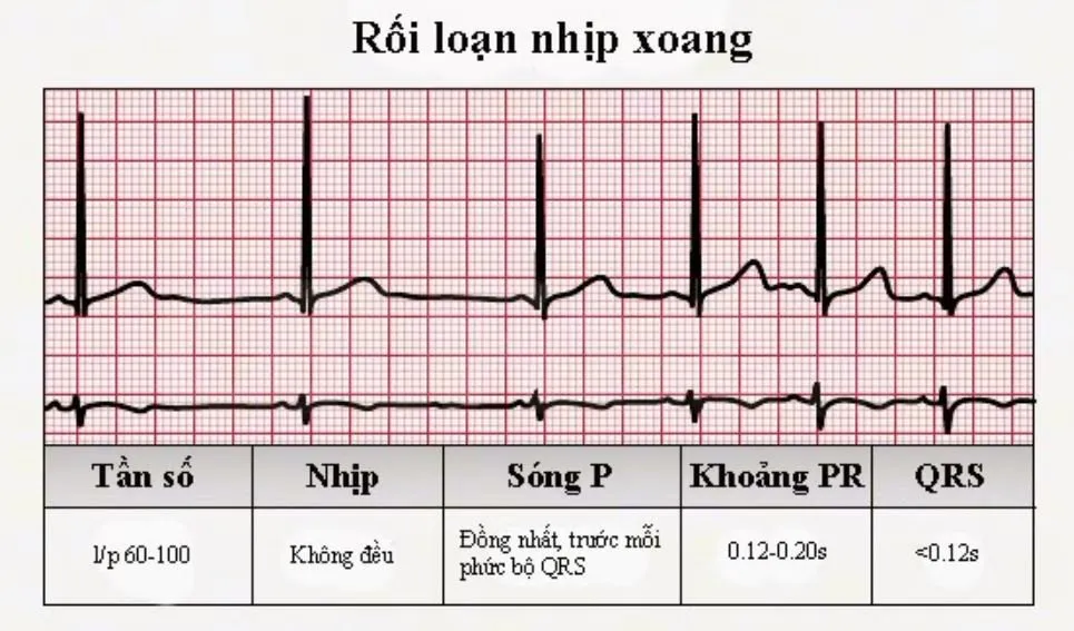Nhịp xoang không đều là gì? Gallery 1