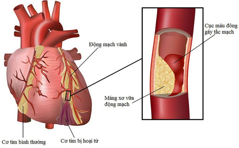 Nhói Tim Khó Thở: Nguyên Nhân, Triệu Chứng Và Cách Xử Trí Gallery 1