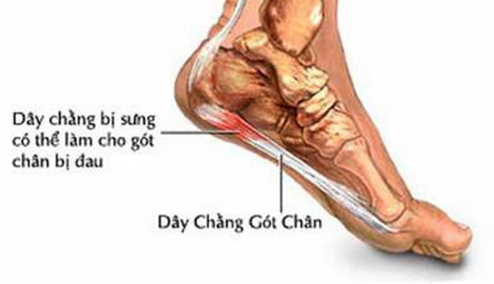 Nhức Gót Chân Trái Gallery 1