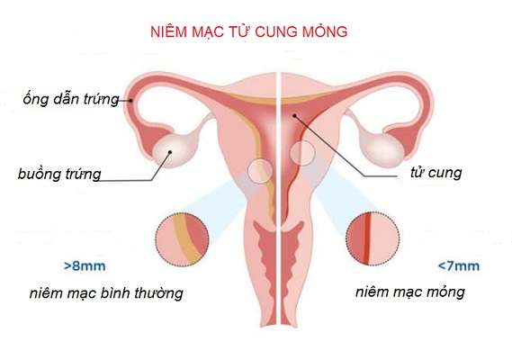Niêm mạc mỏng là gì? Gallery 1