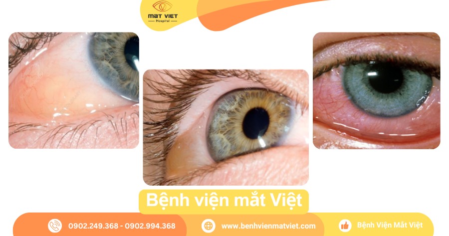 Nổi Bọng Nước Trong Mắt Gallery 1