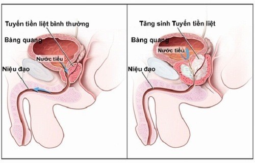 Nốt Vôi Hóa Tiền Liệt Tuyến: Nguyên Nhân, Triệu Chứng Và Điều Trị Gallery 1