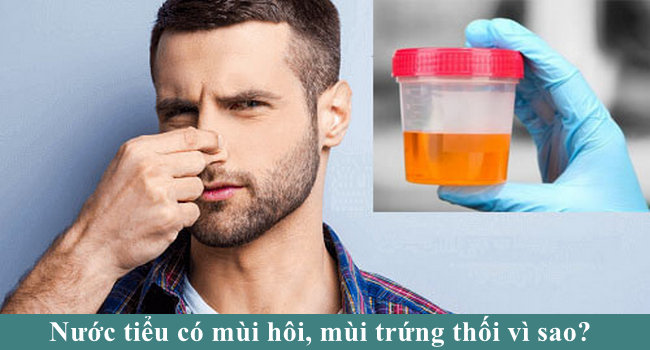 Nước Tiểu Đục Có Mùi Hôi: Nguyên Nhân Và Cách Khắc Phục Gallery 1