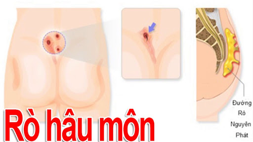 Phát Rồ Là Gì? Gallery 1