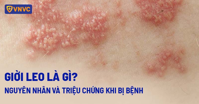 Bị Phong Dời Làm Sao Hết? Gallery 1