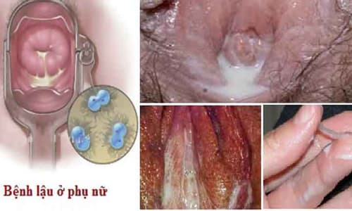 Âm đạo bị lồi: Nguyên nhân, triệu chứng và cách điều trị Gallery 1