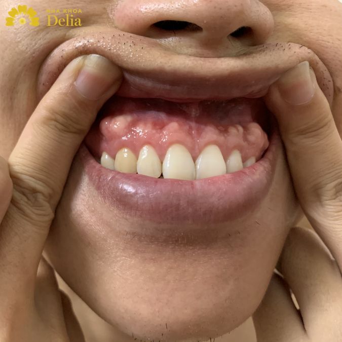 Chân Răng Bị Nhô Ra: Nguyên Nhân, Triệu Chứng và Cách Điều Trị Gallery 1