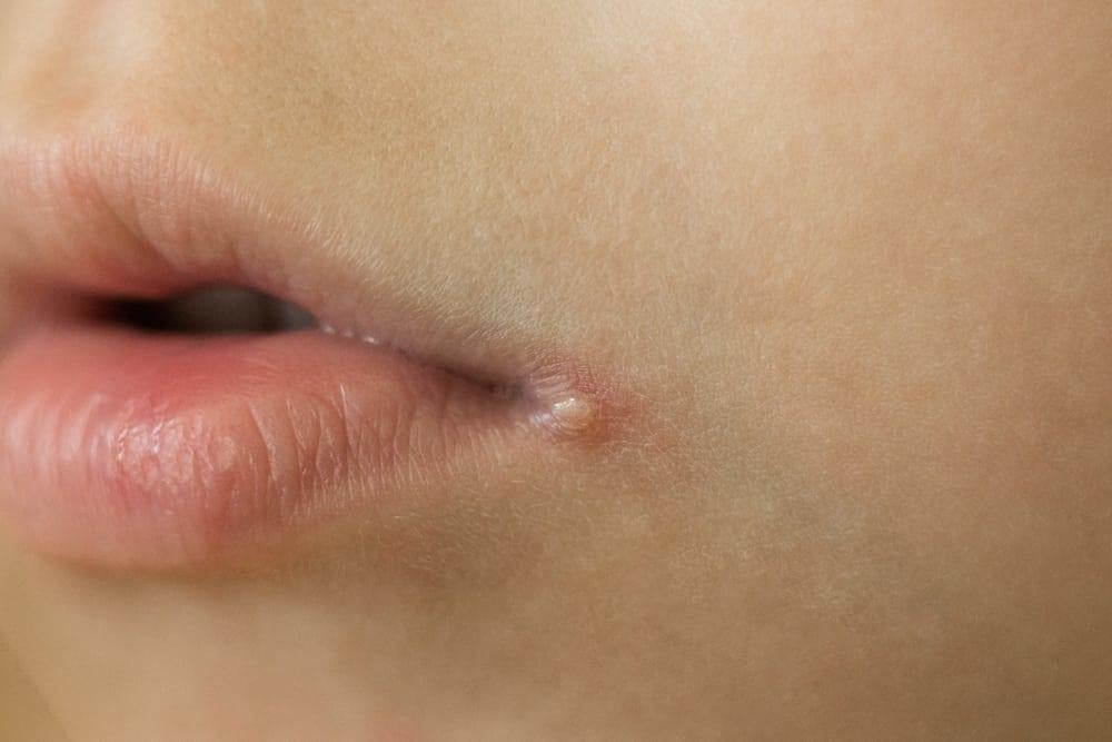 Chốc mép là gì? Gallery 1
