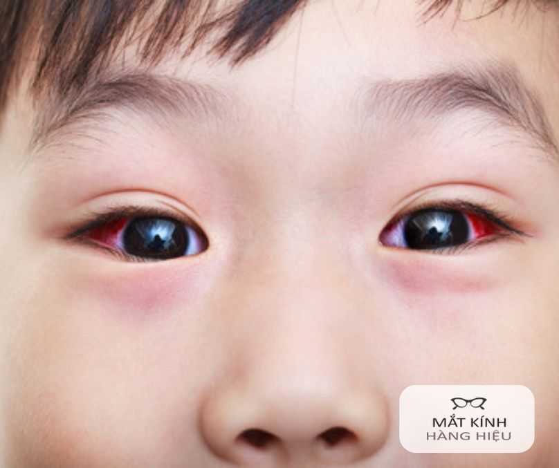 Mắt Đui là gì? Nguyên nhân, triệu chứng và cách điều trị Gallery 1