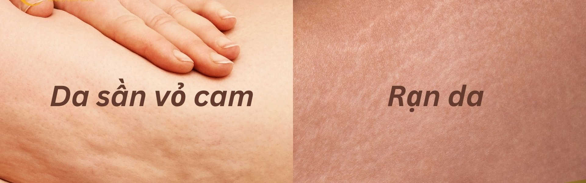 Da sần sùi vỏ cam là gì? Nguyên nhân và cách điều trị Gallery 1