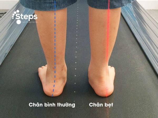 Dáng Đi Bàn Chân Bẹt: Nguyên Nhân, Triệu Chứng Và Cách Khắc Phục Gallery 1
