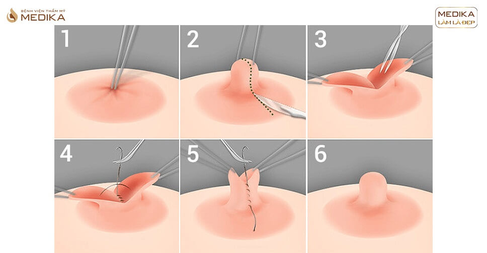 Đầu Ti Bị Thụt: Nguyên Nhân, Triệu Chứng Và Cách Khắc Phục Gallery 1