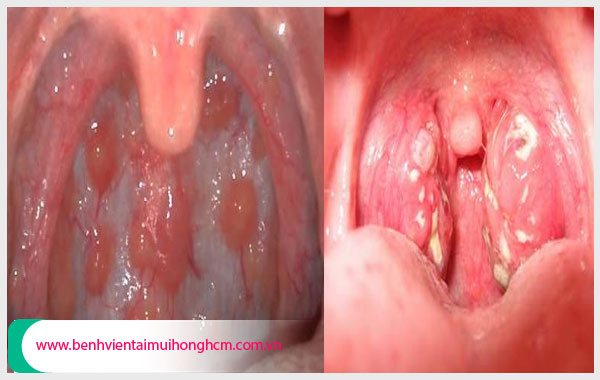 Vòm họng có đốm trắng là bệnh gì? Gallery 1